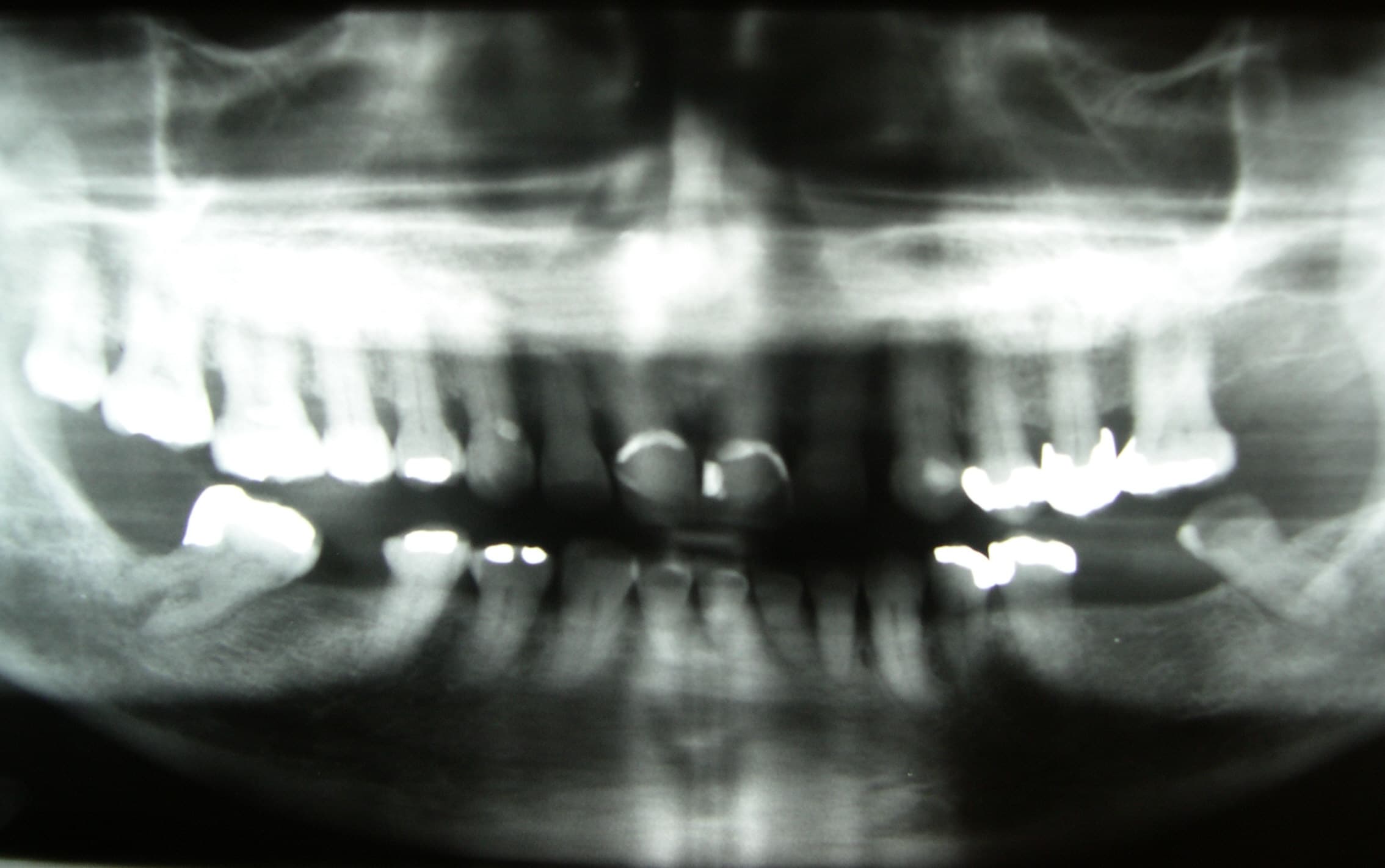 Gercek ortodontik panoramik rontgen ornegi